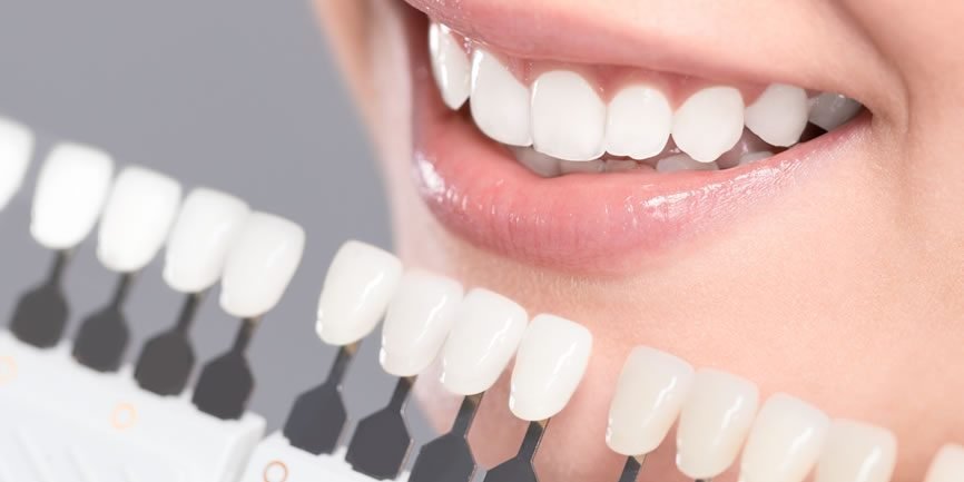 Lente de contato dental em Itaipu